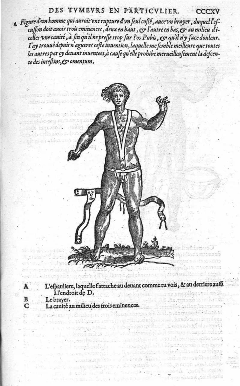 Figura de um homem usando um bragueiro para conter uma hérnia inguinal